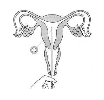 Replacement des embryon dans l'utérus